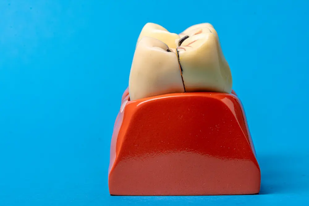 Anatomical dental model illustrating a cracked tooth requiring urgent bonding or crown repair