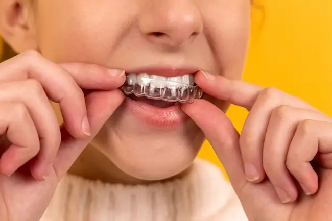 Implant-supported snap-in overdenture model