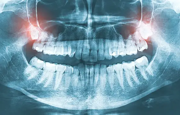Dental X-ray diagnostic scan evaluating root nerve pain and tooth infection in Mesquite, TX